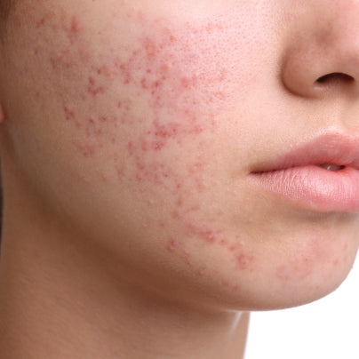 ACNE SKIN