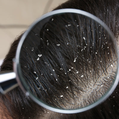 DANDRUFF