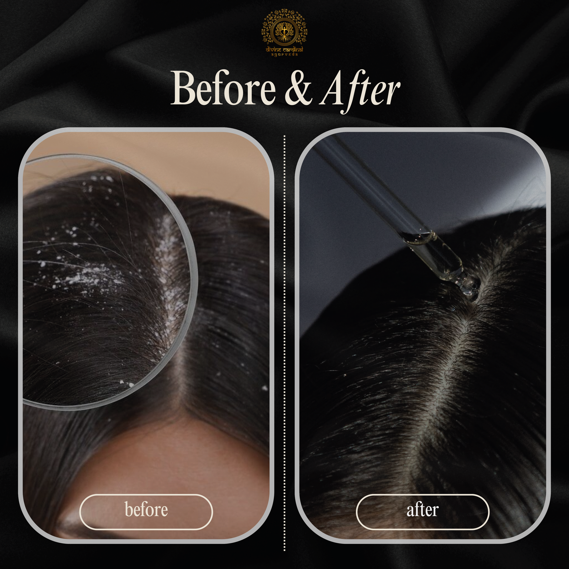 herbal scalp care neem roll on oil for flakes